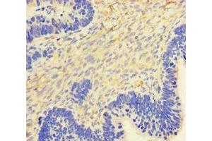 Immunohistochemistry of paraffin-embedded human ovarian cancer using ABIN7154402 at dilution of 1:100 (GM-CSF anticorps  (AA 18-144))