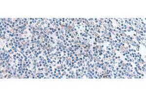 Immunohistochemistry of paraffin-embedded Human tonsil tissue using IL1B Polyclonal Antibody at dilution of 1:55(x200) (IL-1 beta anticorps)