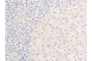 ABIN6267268 at 1/100 staining human liver cancer tissue sections by IHC-P. (EGFR anticorps  (pSer1026))