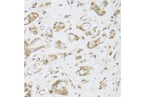 Immunohistochemistry of paraffin-embedded human gastric cancer using DMAP1 antibody (ABIN6003515) at dilution of 1/100 (40x lens). (DMAP1 anticorps)