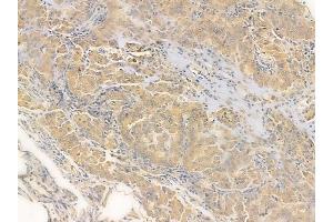 ABIN6265558 and ABIN6278387 at 1/100 staining human lung adenocarcinoma by IHC-P.
