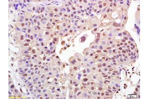 Formalin-fixed and paraffin embedded human bladder carcinoma labeled with Rabbit Anti FOXO1A Polyclonal Antibody, Unconjugated (ABIN1387620) at 1:200 followed by conjugation to the secondary antibody and DAB staining (FOXO1 anticorps  (AA 165-270))