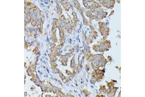Immunohistochemistry of paraffin-embedded human thyroid cancer using HAL antibody (ABIN6130467, ABIN6141593, ABIN6141594 and ABIN6216851) at dilution of 1:100 (40x lens). (HAL anticorps  (AA 1-200))