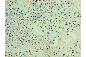 Immunohistochemistry of paraffin-embedded human breast cancer using ABIN7166888 at dilution of 1:100