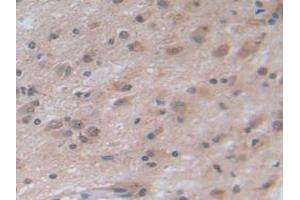IHC-P analysis of Human Glioma Tissue, with DAB staining. (NOTCH4 anticorps  (AA 1715-2001))
