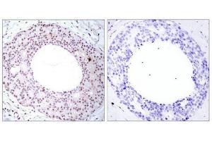 Immunohistochemical analysis of paraffin-embedded human breast carcinoma tissue using NFkB-p65(Phospho-Thr254) Antibody(left) or the same antibody preincubated with blocking peptide(right). (NF-kB p65 anticorps  (pThr254))