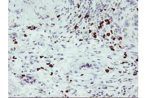 Immunohistochemical staining of paraffin-embedded Carcinoma of Human lung tissue using anti-PADI4 mouse monoclonal antibody. (PAD4 anticorps)