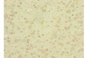 Immunohistochemistry of paraffin-embedded human glioma using ABIN7166564 at dilution of 1:100 (PCDH19 anticorps  (AA 568-678))