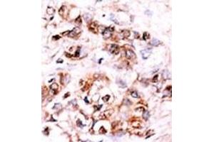 Formalin-fixed and paraffin-embedded human cancer tissue reacted with the primary antibody, which was peroxidase-conjugated to the secondary antibody, followed by AEC staining.