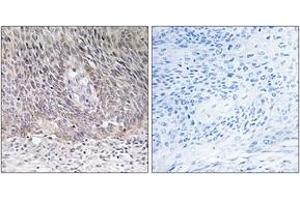 Immunohistochemistry analysis of paraffin-embedded human cervix carcinoma tissue, using ARSA Antibody. (Arylsulfatase A anticorps  (AA 251-300))