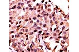 IHC analysis of FFPE human breast carcinoma stained with the PPP3CC antibody (PPP3CC anticorps  (AA 18-47))