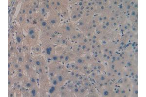 IHC-P analysis of Human Liver cancer Tissue, with DAB staining. (IGF2BP2 anticorps  (AA 141-384))