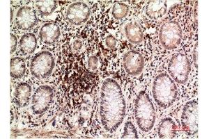 Immunohistochemical analysis of paraffin-embedded Human Colon Carcinoma Tissue using Epsilon Tubulin Mouse mAb diluted at 1:200. (TUBE1 anticorps)