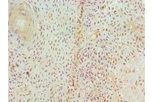 Immunohistochemistry of paraffin-embedded human breast cancer using ABIN7153952 at dilution of 1:100