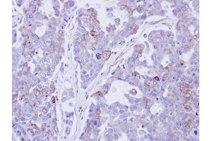 IHC-P Image Immunohistochemical analysis of paraffin-embedded OVCAR3 xenograft , using Desmocollin 2 , antibody at 1:500 dilution. (Desmocollin 2 anticorps)