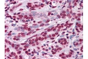 Immunohistochemical analysis of paraffin-embedded human Breast tissues using anti-ZBTB7B antibody (ZBTB7B anticorps)