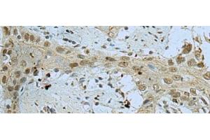 Immunohistochemistry of paraffin-embedded Human esophagus cancer tissue using WDR4 Polyclonal Antibody at dilution of 1:40(x200) (WDR4 anticorps)