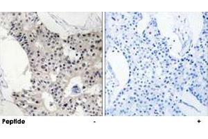 Immunohistochemistry analysis of paraffin-embedded human breast carcinoma tissue using BAGE4 polyclonal antibody . (BAGE4 anticorps  (Internal Region))