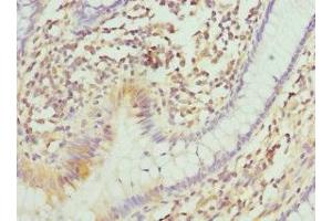 Immunohistochemistry of paraffin-embedded human colon cancer using ABIN7147369 at dilution of 1:100 (ITGB3BP anticorps  (AA 1-177))