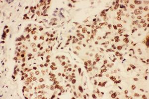 Anti-BRCA1 Picoband antibody,  IHC(P): Human Mammary Cancer Tissue