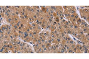 Immunohistochemistry of paraffin-embedded Human liver cancer using Cyclophilin F Polyclonal Antibody at dilution of 1:45 (PPIF anticorps)