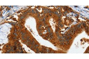 Immunohistochemistry of paraffin-embedded Human colon cancer tissue using IL20RA Polyclonal Antibody at dilution 1:35 (IL20RA anticorps)