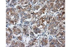 Immunohistochemical staining of paraffin-embedded Carcinoma of liver tissue using anti-BSG mouse monoclonal antibody. (CD147 anticorps)