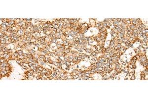 Immunohistochemistry of paraffin-embedded Human liver cancer tissue using NR0B2 Polyclonal Antibody at dilution of 1:35(x200)