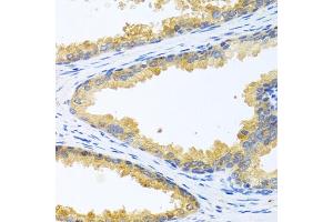 Immunohistochemistry of paraffin-embedded human prostate using KLK11 antibody (ABIN6129403, ABIN6142946, ABIN6142948 and ABIN6216242) at dilution of 1:100 (40x lens). (Kallikrein 11 anticorps  (AA 1-250))