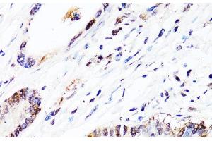 Immunohistochemistry of paraffin-embedded Human colon carcinoma using FGF12 Polyclonal Antibody at dilution of 1:150 (40x lens). (FGF12 anticorps)