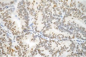 Immunohistochemistry was performed on paraffin-embedded human endometrial carcinoma using phospho-vimentin (Ser56) antibody (ABIN7800834), 1:100).