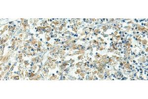 Immunohistochemistry of paraffin-embedded Human liver cancer tissue using FCGRT Polyclonal Antibody at dilution of 1:45(x200) (FcRn anticorps)