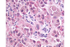 Anti-GRM3 / MGLUR3 antibody IHC of human Skin, Melanoma.