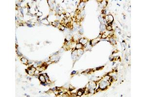 Anti-MEK3 antibody, IHC(P) IHC(P): Human Mammary Cancer Tissue