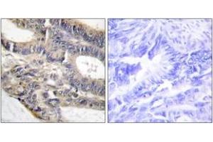 Immunohistochemistry analysis of paraffin-embedded human colon carcinoma tissue, using AS250 Antibody.