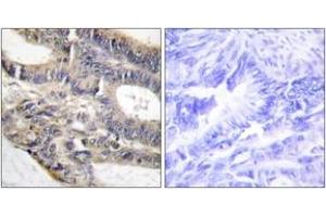 Immunohistochemistry analysis of paraffin-embedded human colon carcinoma tissue, using AS250 Antibody. (RALGAPA2 anticorps  (AA 641-690))
