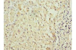 Immunohistochemistry of paraffin-embedded human liver cancer using ABIN7172975 at dilution of 1:100 (TMED2 anticorps  (AA 26-111))