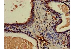Immunohistochemistry of paraffin-embedded human prostate cancer using ABIN7146559 at dilution of 1:100 (CNN3 anticorps  (AA 2-329))