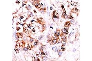 IHC analysis of FFPE human hepatocarcinoma stained with the DUSP15 antibody