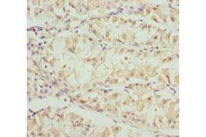 Immunohistochemistry of paraffin-embedded human gastric cancer using ABIN7162248 at dilution of 1:100 (OPA3 anticorps  (AA 25-179))