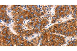 Immunohistochemistry of paraffin-embedded Human liver cancer tissue using KCNC2 Polyclonal Antibody at dilution 1:100 (KCNC2 anticorps)
