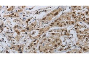 Immunohistochemistry of paraffin-embedded Human lung cancer using PRKAR1B Polyclonal Antibody at dilution of 1:70 (PRKAR1B anticorps)