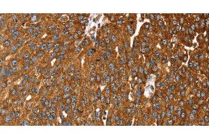 Immunohistochemistry of paraffin-embedded Human breast cancer tissue using RASSF3 Polyclonal Antibody at dilution 1:35 (RASSF3 anticorps)