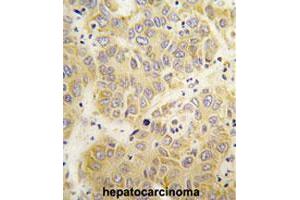 Formalin-fixed and paraffin-embedded human hepatocarcinomareacted with VARS polyclonal antibody , which was peroxidase-conjugated to the secondary antibody, followed by AEC staining. (VARS anticorps  (N-Term))