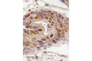 Immunohistochemistry analyzes of paraffin-embedded human colon carcinoma tissue using DIDO1 antibody . (DIDO1 anticorps)
