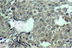 Immunohistochemistry (IHC) analyzes of p-MEK-1/2 antibody in paraffin-embedded human breast carcinoma tissue. (MEK1 anticorps  (pSer222, pSer226))