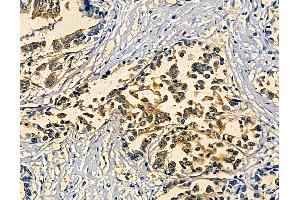 ABIN7094923 and ABIN7098979 at 1/100 staining human pancreatic cancer and adjacent non-tumor tissue by IHC-P. (SOX30 anticorps)