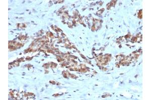 Formalin-fixed, paraffin-embedded human Breast stained with ARF1 Mouse Monoclonal Antibody (ARF1/2117). (ARF1 anticorps)