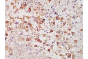 Formalin-fixed and paraffin embedded human lung carcinoma labeled with Rabbit Anti-CK7 Polyclonal Antibody, Unconjugated  at 1:200 followed by conjugation to the secondary antibody and DAB staining