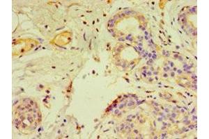 Immunohistochemistry of paraffin-embedded human breast cancer using ABIN7153805 at dilution of 1:100 (GTF2H2C anticorps  (AA 1-260))